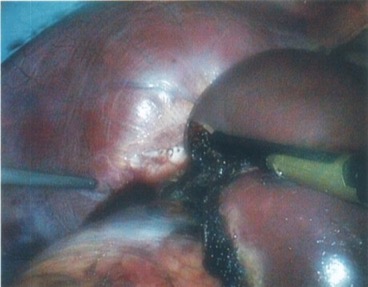 right lobe resected ad